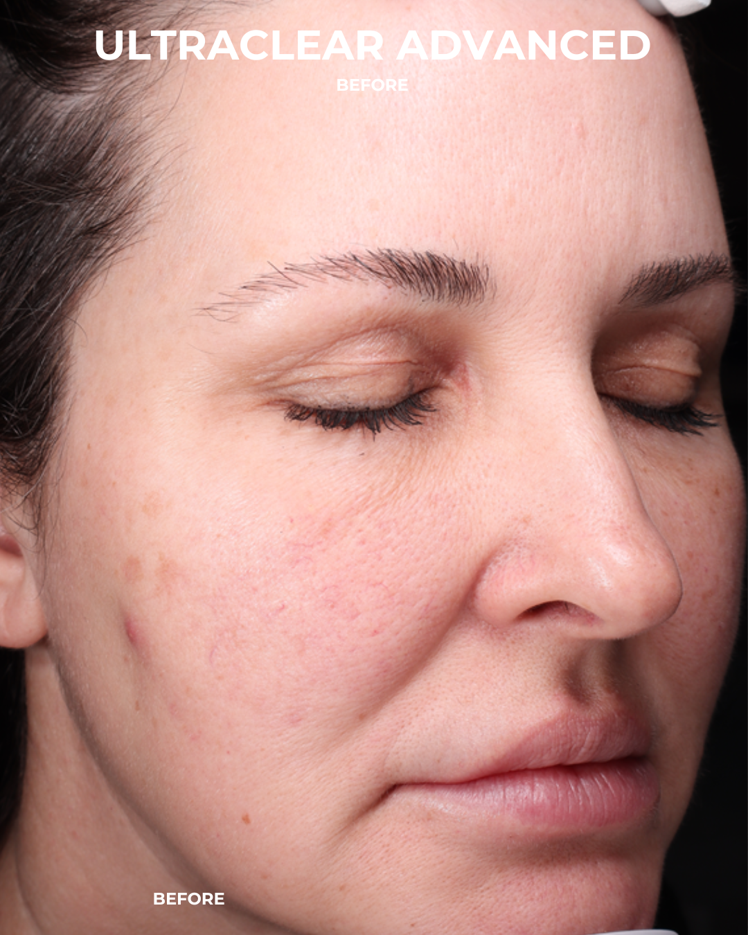 UltraClear Before & After Gallery - Patient 223793 - Image 3