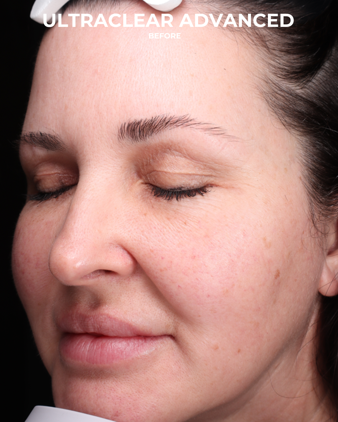 UltraClear Before & After Gallery - Patient 223793 - Image 5