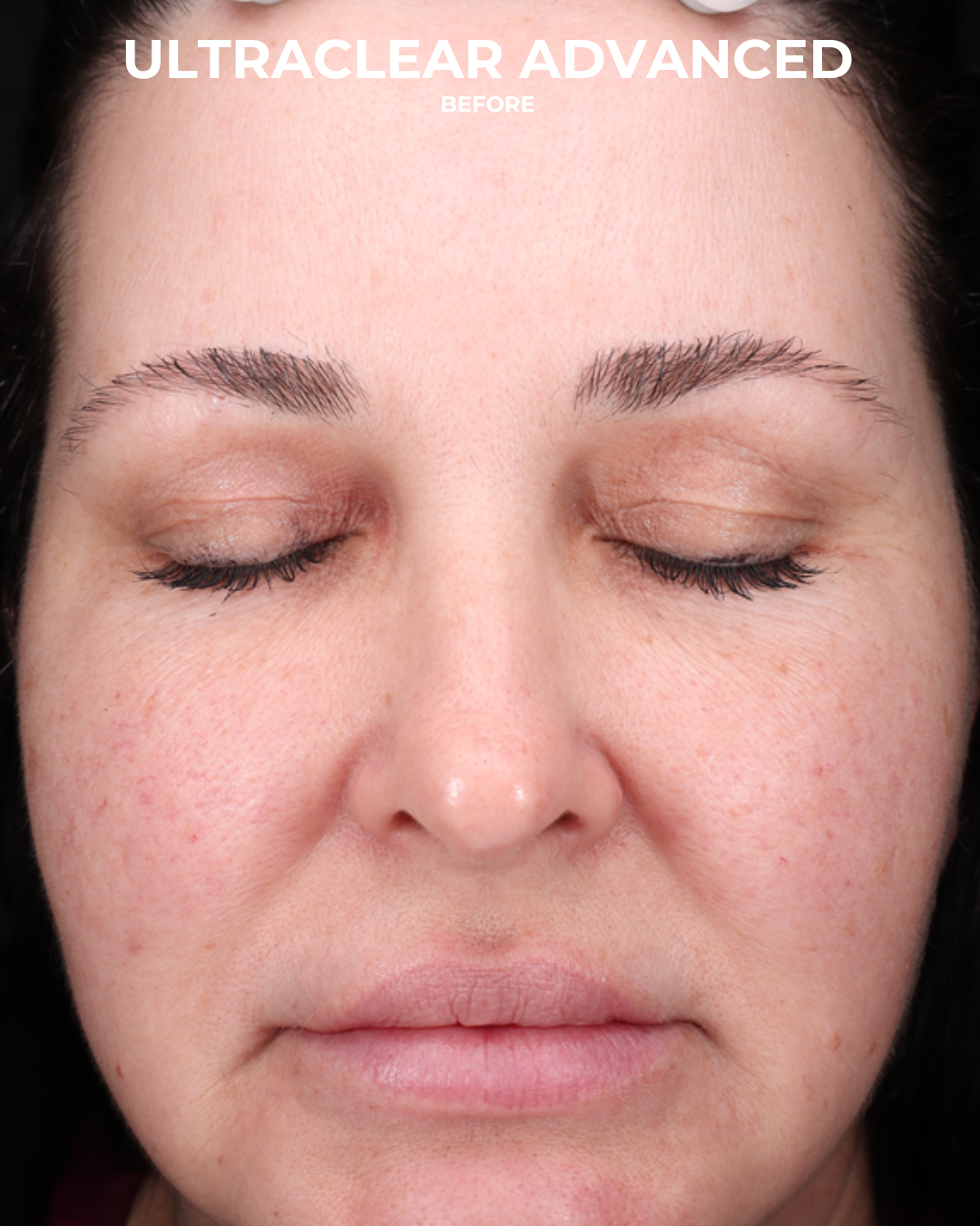 UltraClear Before & After Gallery - Patient 223793 - Image 1