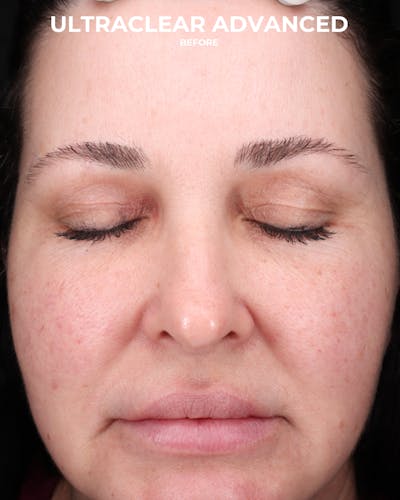 UltraClear Before & After Gallery - Patient 223793 - Image 1