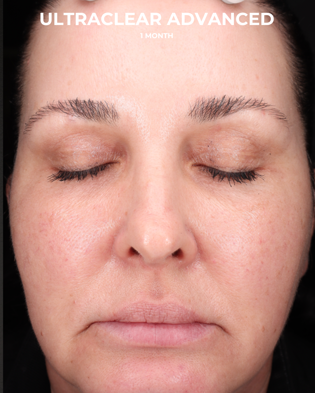 UltraClear Before & After Gallery - Patient 223793 - Image 2