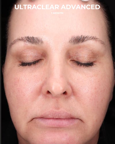 UltraClear Before & After Gallery - Patient 223793 - Image 2