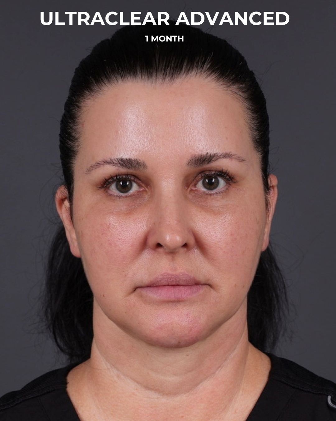 UltraClear Before & After Gallery - Patient 223793 - Image 8