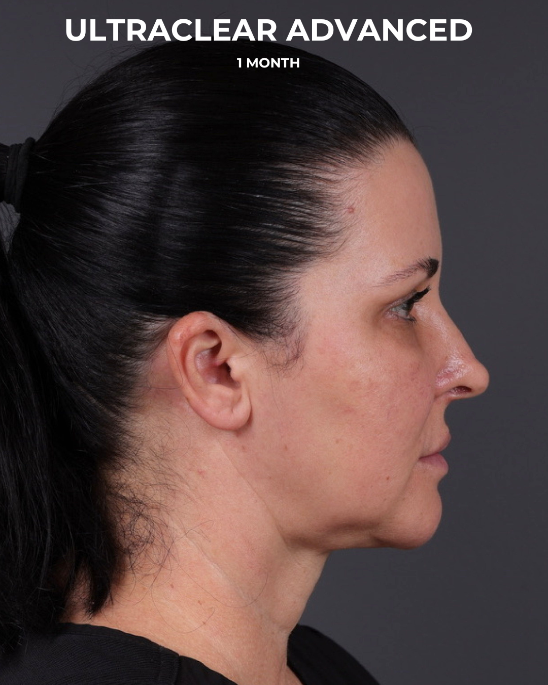 UltraClear Before & After Gallery - Patient 223793 - Image 12