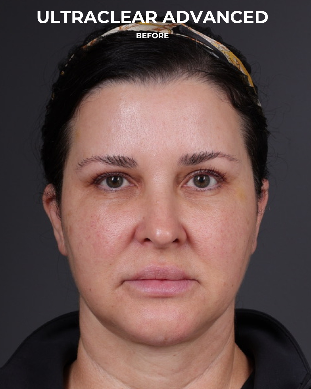 UltraClear Before & After Gallery - Patient 223793 - Image 7