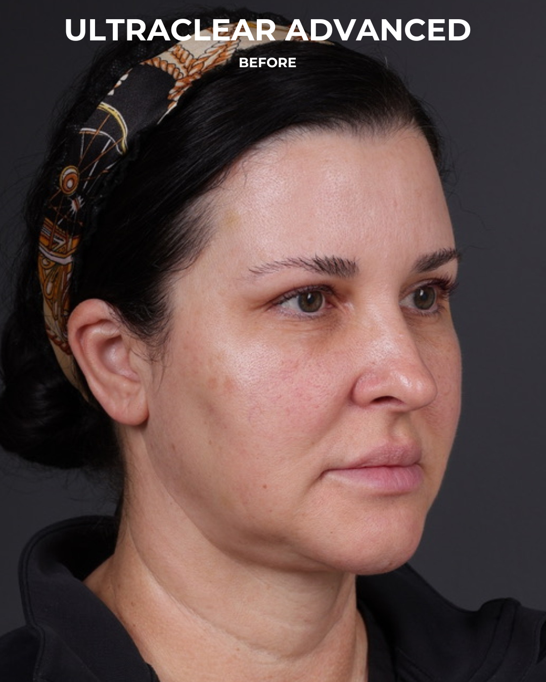 UltraClear Before & After Gallery - Patient 223793 - Image 9