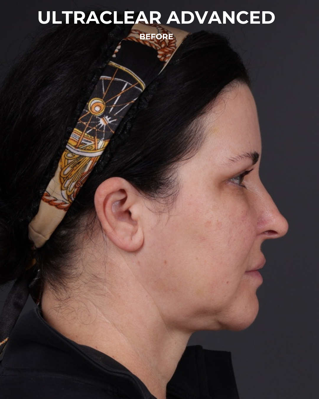 UltraClear Before & After Gallery - Patient 223793 - Image 11