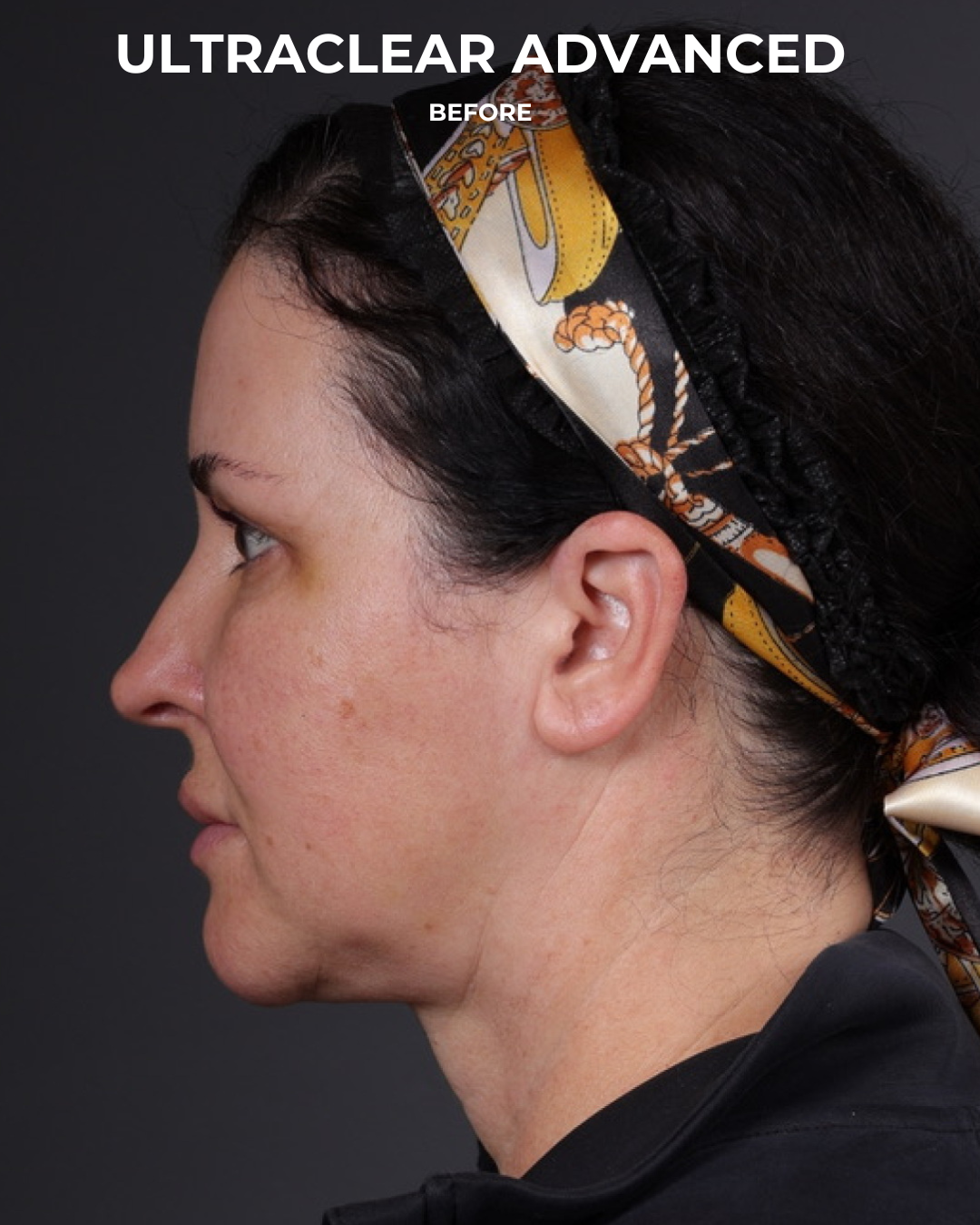 UltraClear Before & After Gallery - Patient 223793 - Image 13