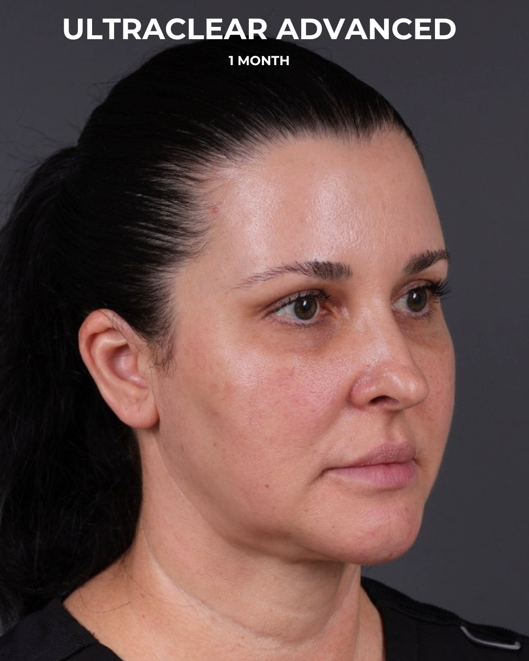 UltraClear Before & After Gallery - Patient 223793 - Image 10