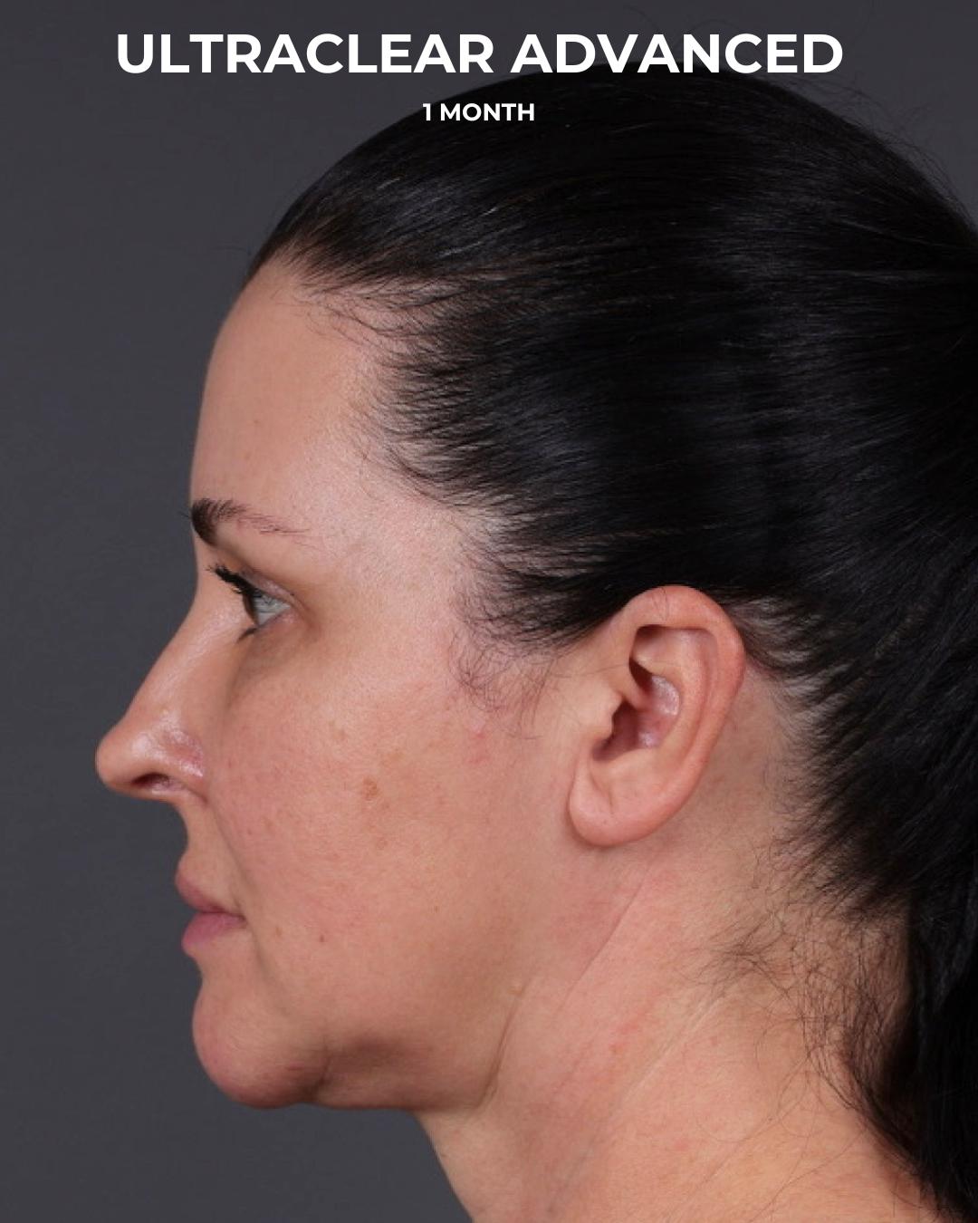 UltraClear Before & After Gallery - Patient 223793 - Image 14