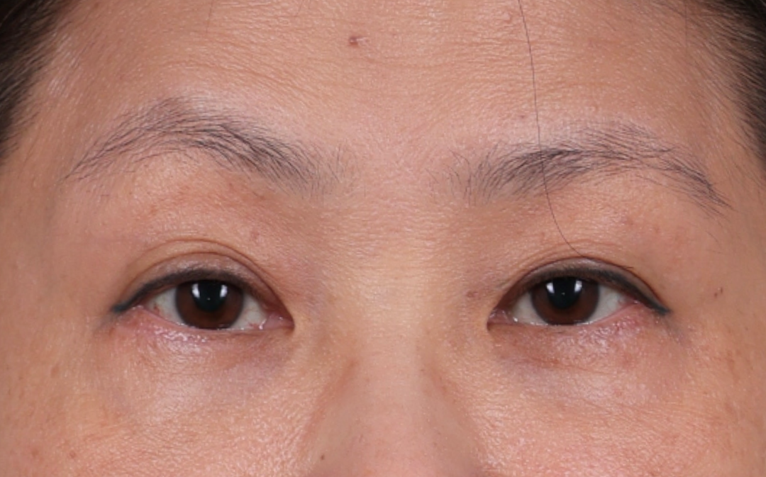 Blepharoplasty Before & After Gallery - Patient 188224 - Image 2