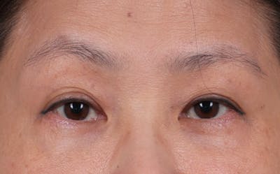 Blepharoplasty Before & After Gallery - Patient 188224 - Image 2