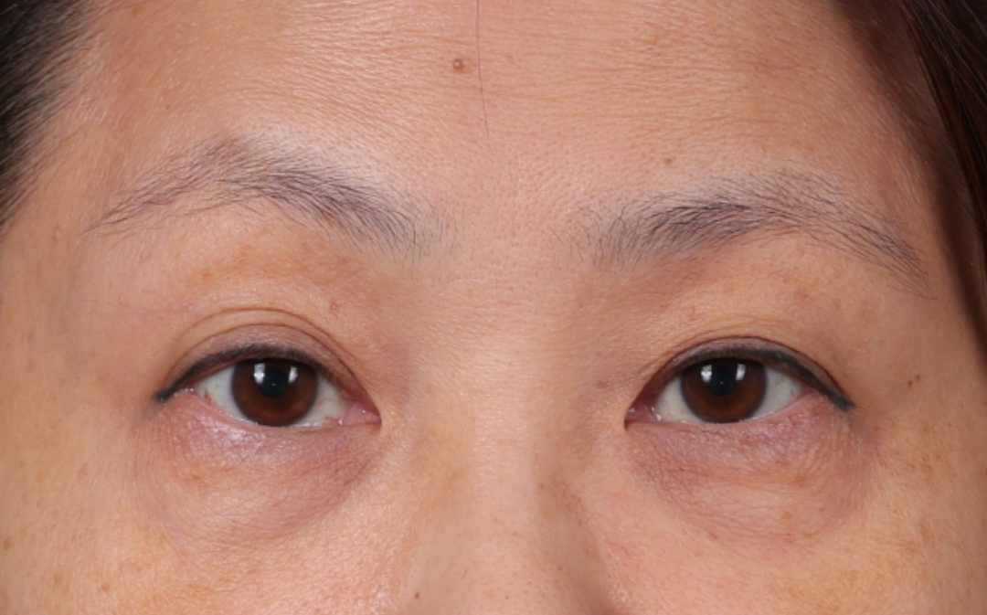 Blepharoplasty Before & After Gallery - Patient 188224 - Image 1