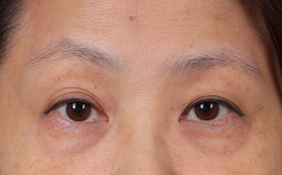 Blepharoplasty Before & After Gallery - Patient 188224 - Image 1
