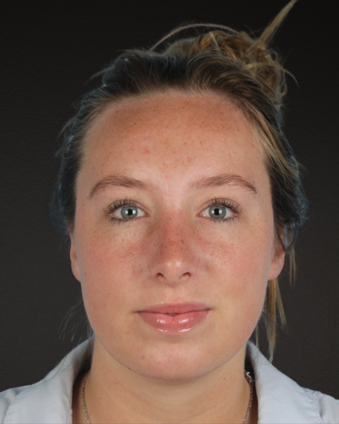 Rhinoplasty Before & After Gallery - Patient 356462 - Image 4