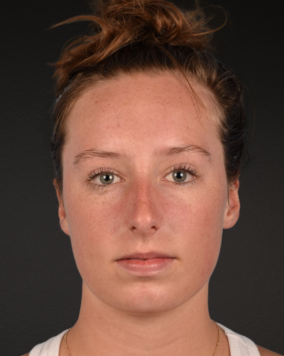Rhinoplasty Before & After Gallery - Patient 356462 - Image 3