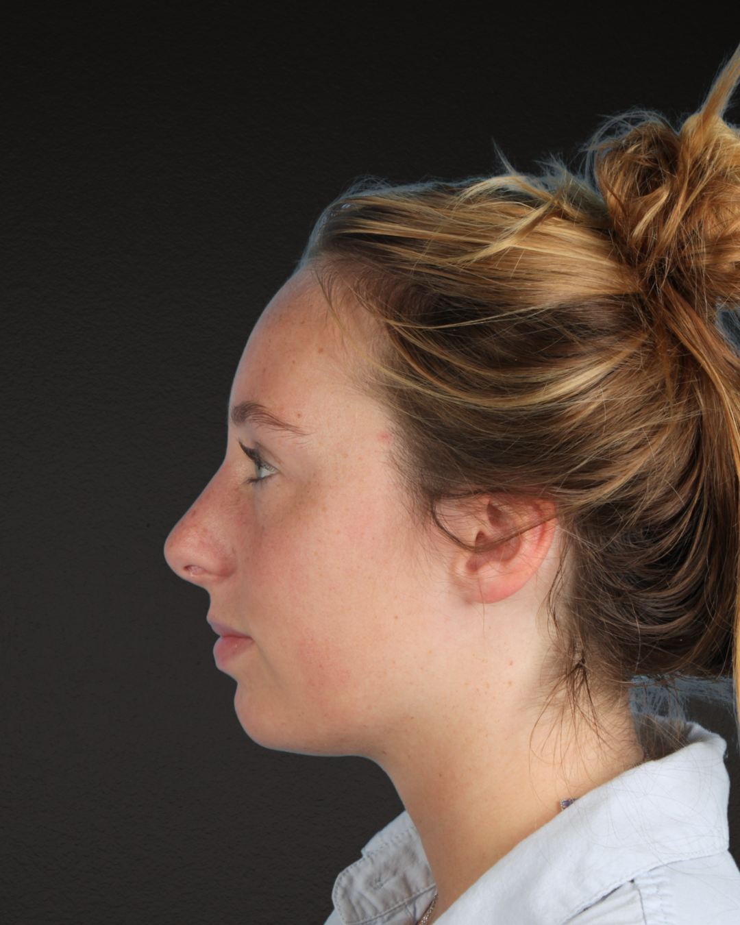 Rhinoplasty Before & After Gallery - Patient 356462 - Image 10