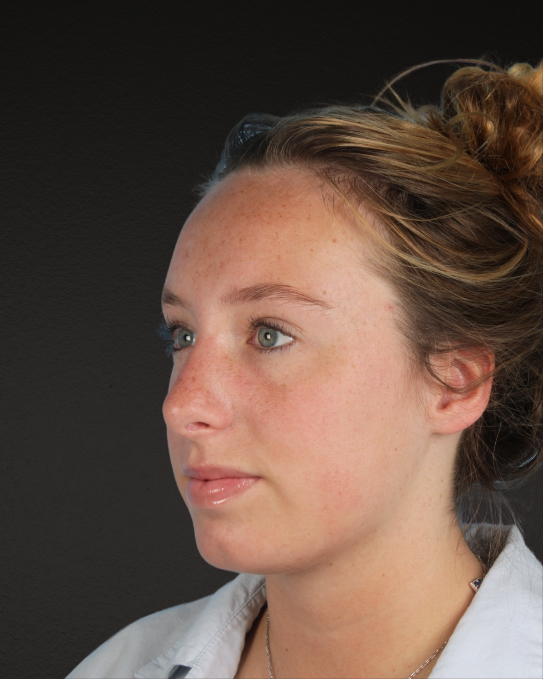 Rhinoplasty Before & After Gallery - Patient 356462 - Image 6
