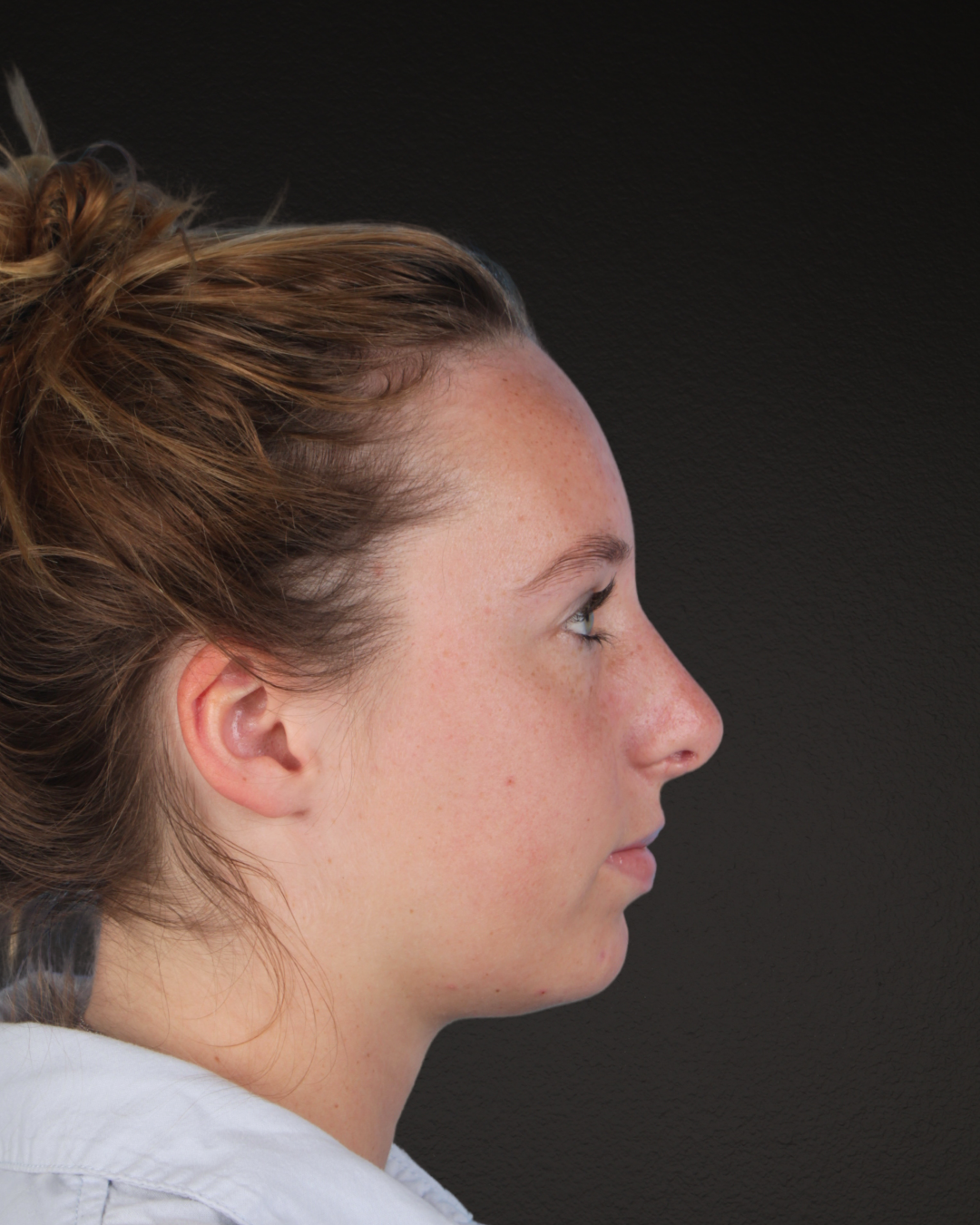 Rhinoplasty Before & After Gallery - Patient 356462 - Image 2