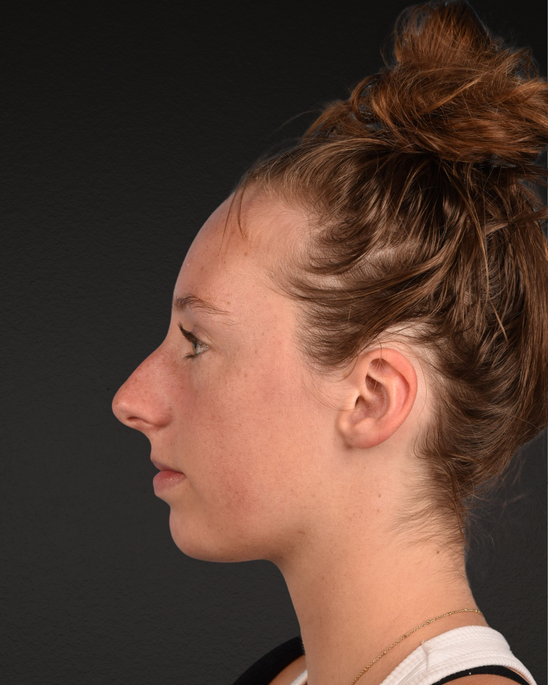 Rhinoplasty Before & After Gallery - Patient 356462 - Image 9