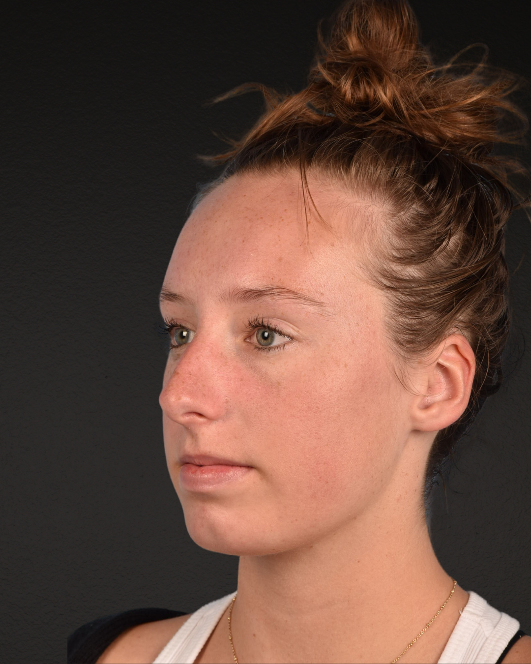 Rhinoplasty Before & After Gallery - Patient 356462 - Image 5