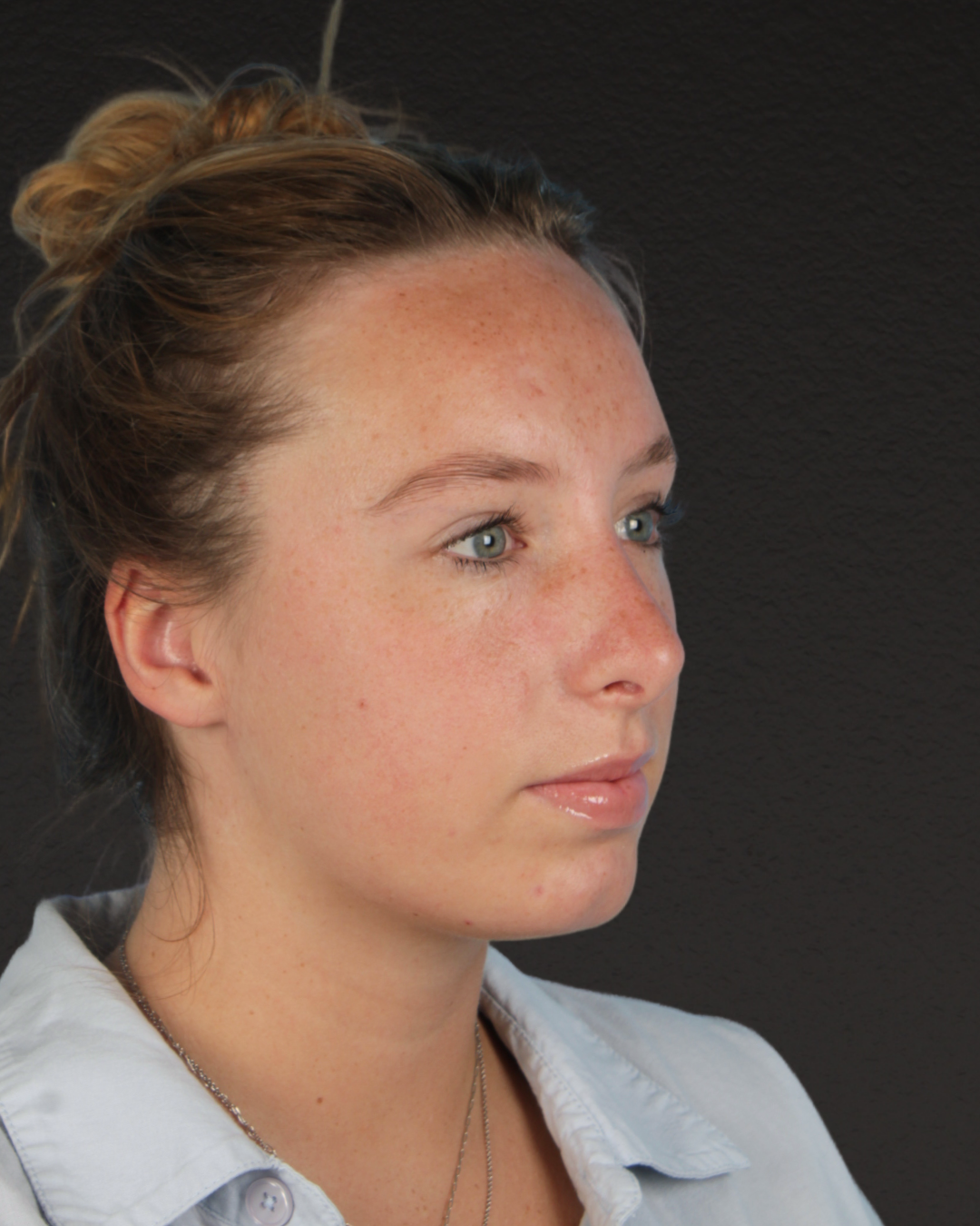 Rhinoplasty Before & After Gallery - Patient 356462 - Image 8