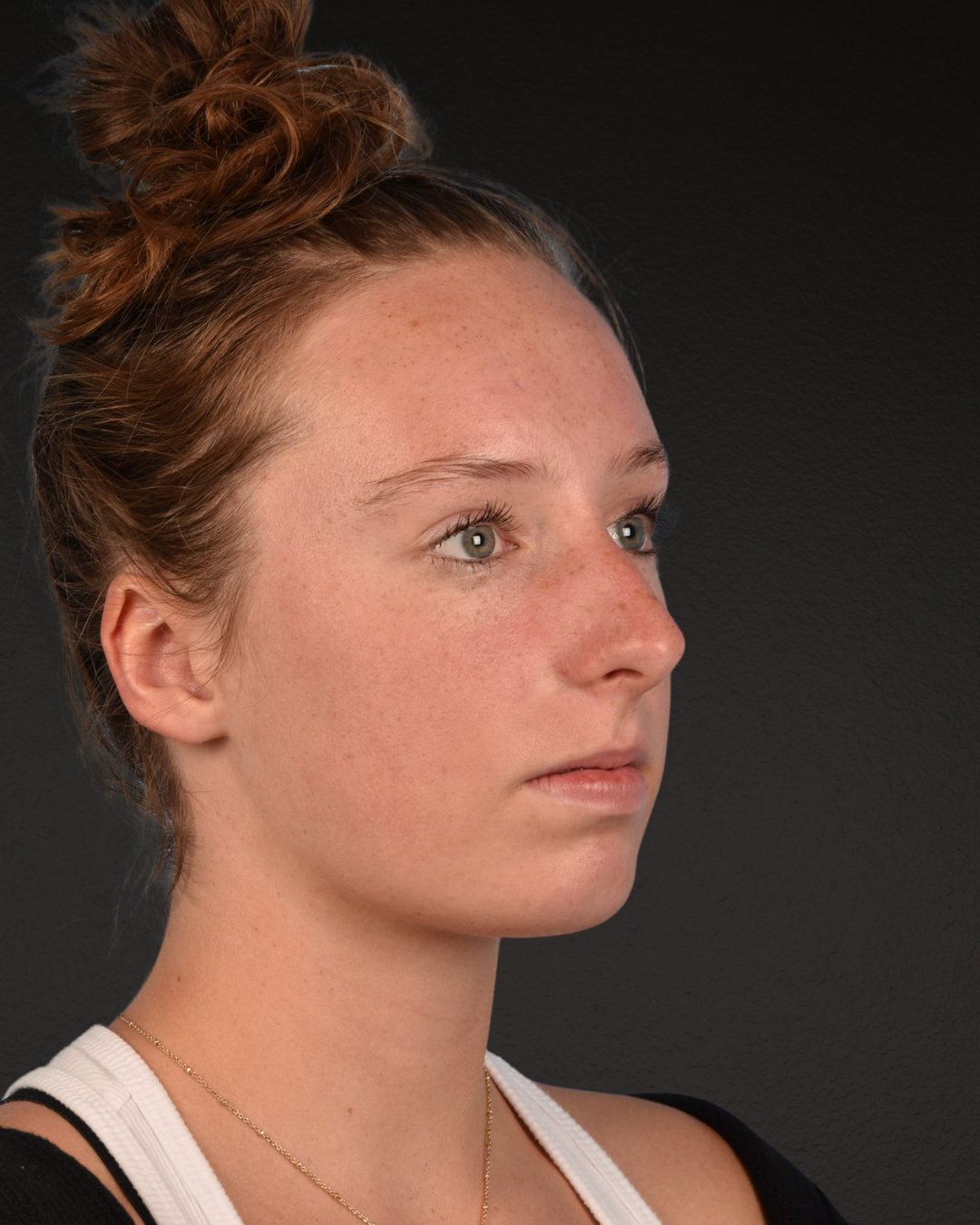 Rhinoplasty Before & After Gallery - Patient 356462 - Image 7