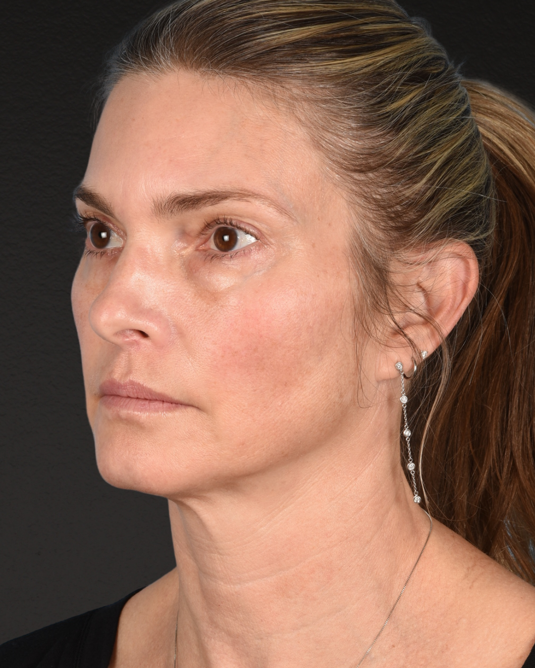 Facelift Before & After Gallery - Patient 127422 - Image 3