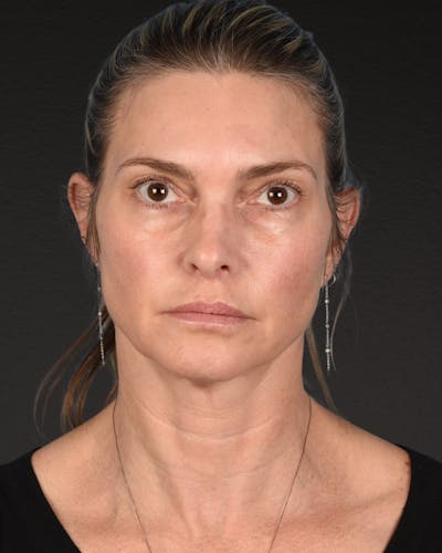 Facelift Before & After Gallery - Patient 127422 - Image 1