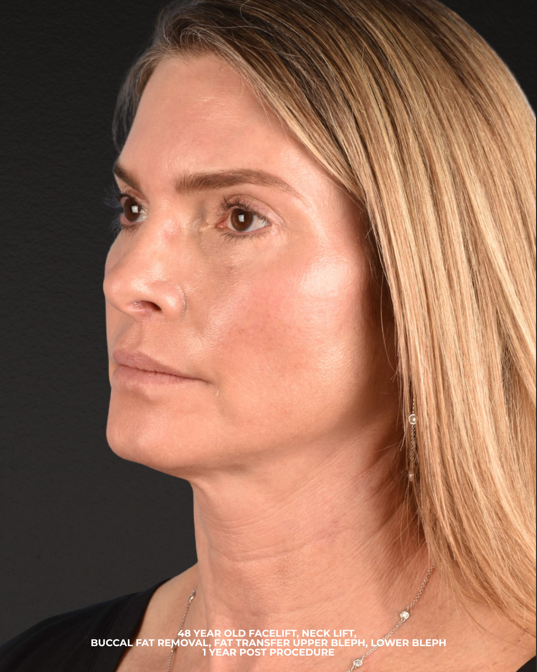 Facelift Before & After Gallery - Patient 127422 - Image 4