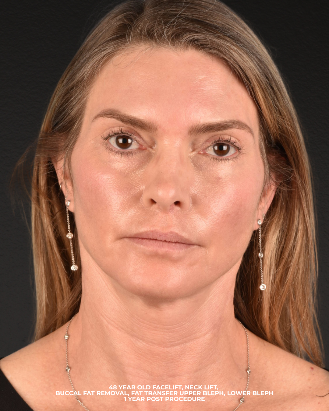 Facelift Before & After Gallery - Patient 127422 - Image 2