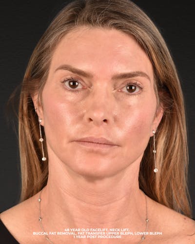 Facelift Before & After Gallery - Patient 127422 - Image 2