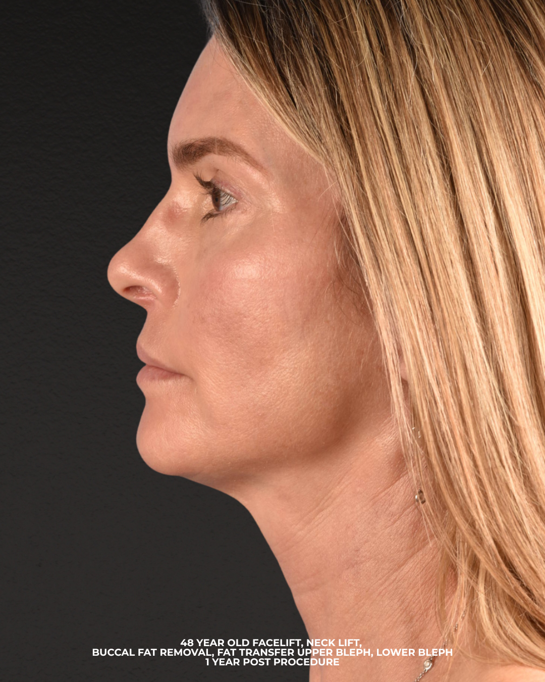 Facelift Before & After Gallery - Patient 127422 - Image 6