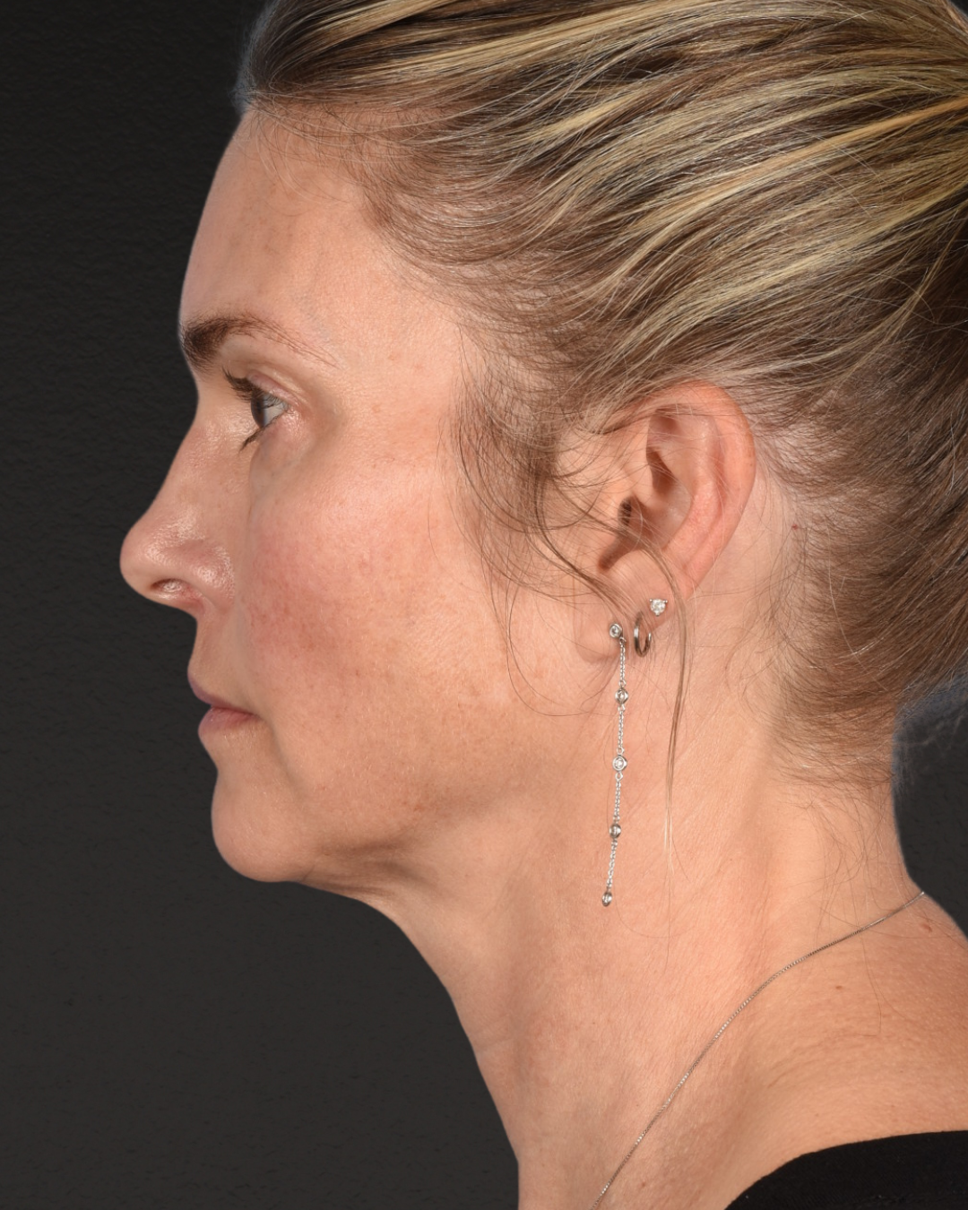 Facelift Before & After Gallery - Patient 127422 - Image 5
