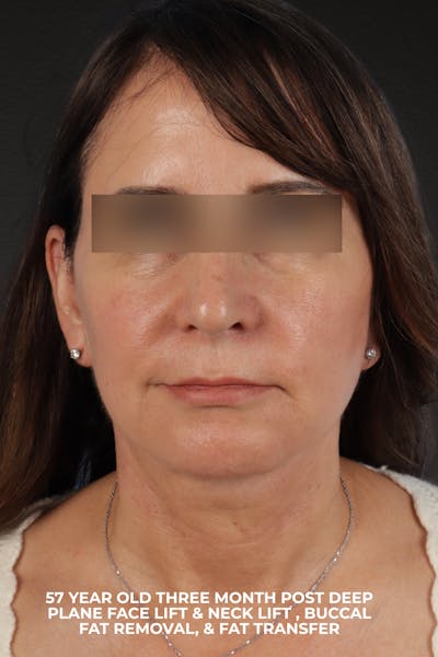 Facelift Before & After Gallery - Patient 407291 - Image 2