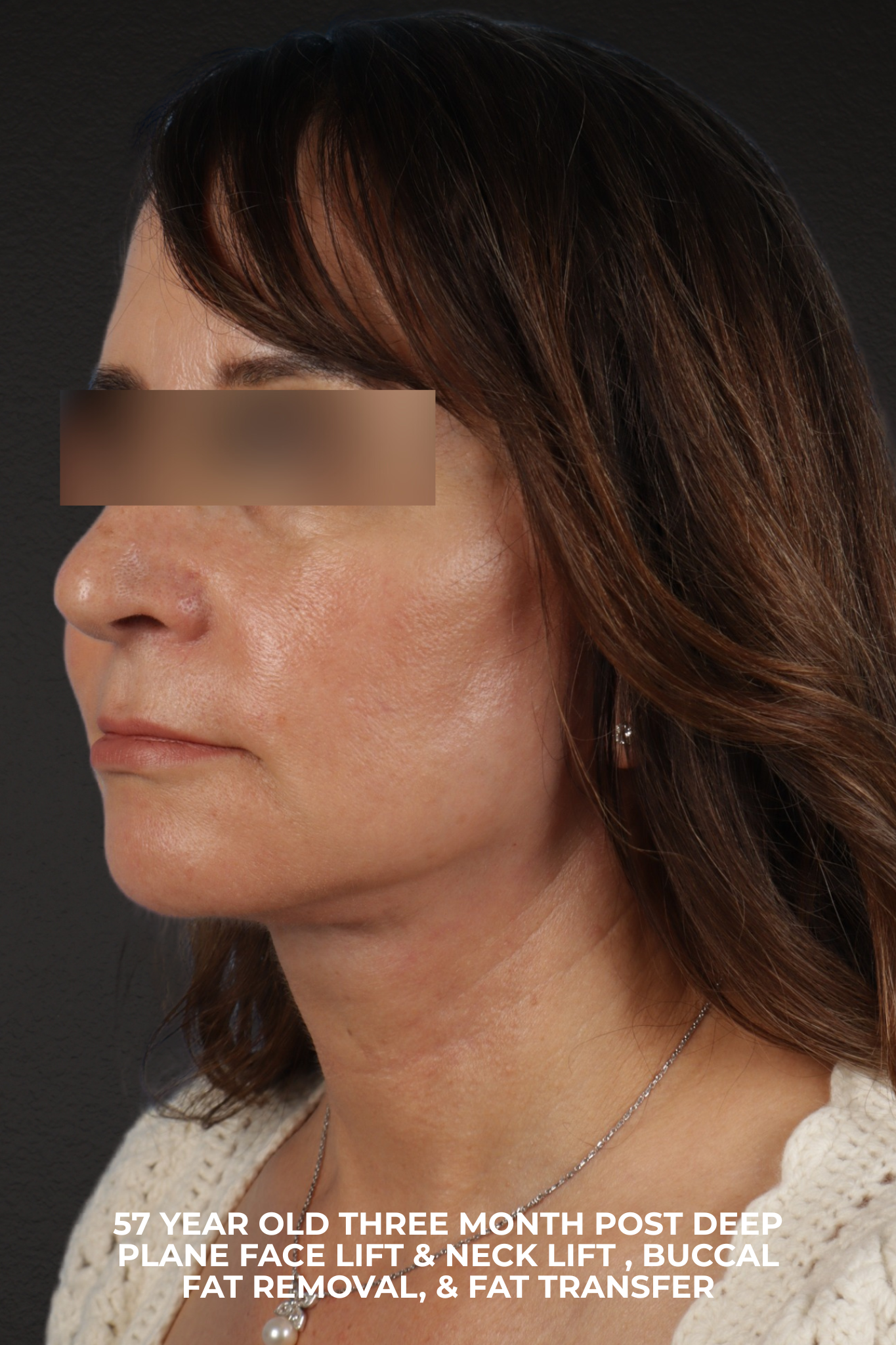 Facelift Before & After Gallery - Patient 407291 - Image 8