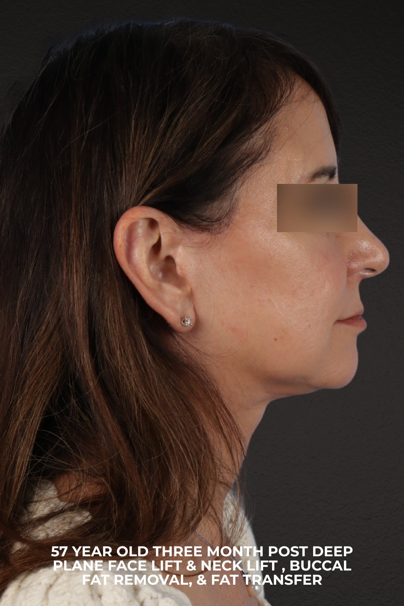 Facelift Before & After Gallery - Patient 407291 - Image 10