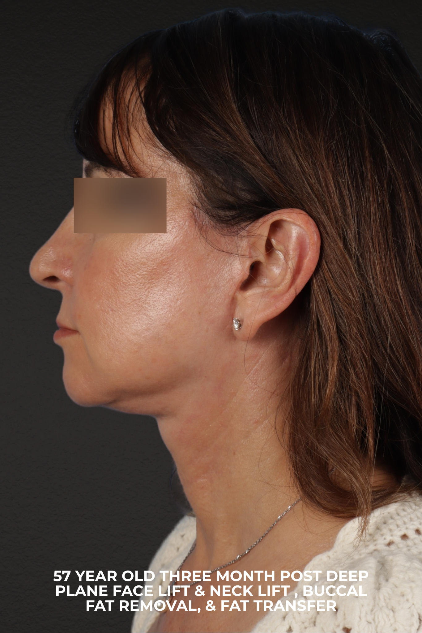 Facelift Before & After Gallery - Patient 407291 - Image 4