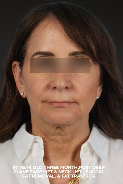 Facelift Before & After Gallery - Patient 407291 - Image 1