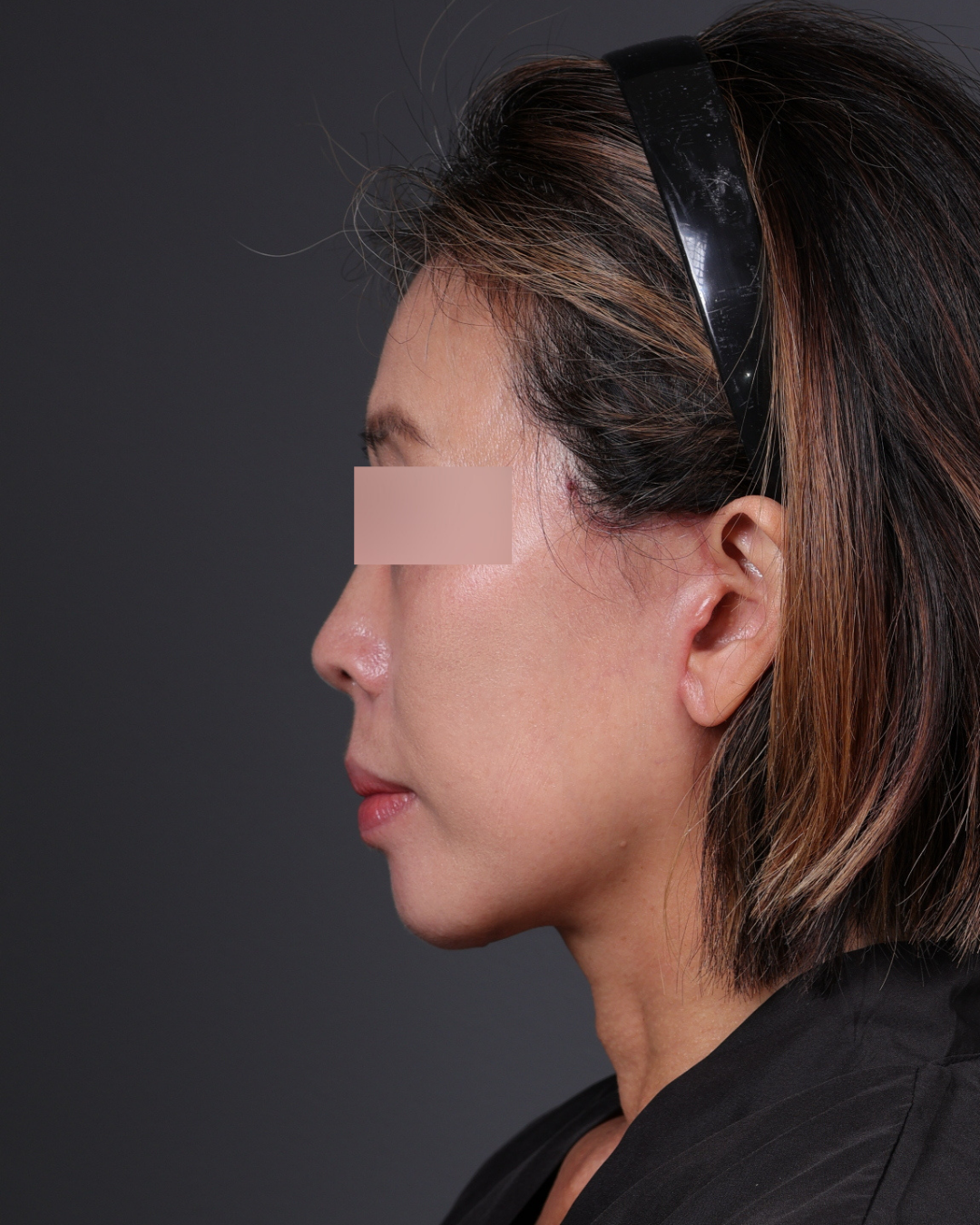 Facelift Before & After Gallery - Patient 178633 - Image 10