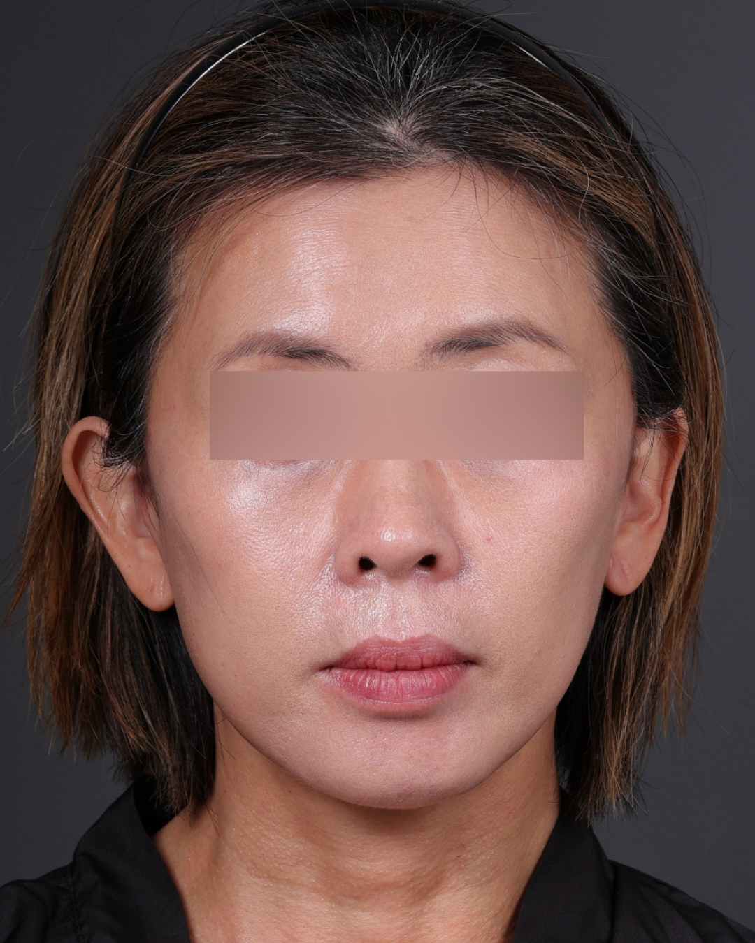 Facelift Before & After Gallery - Patient 178633 - Image 6