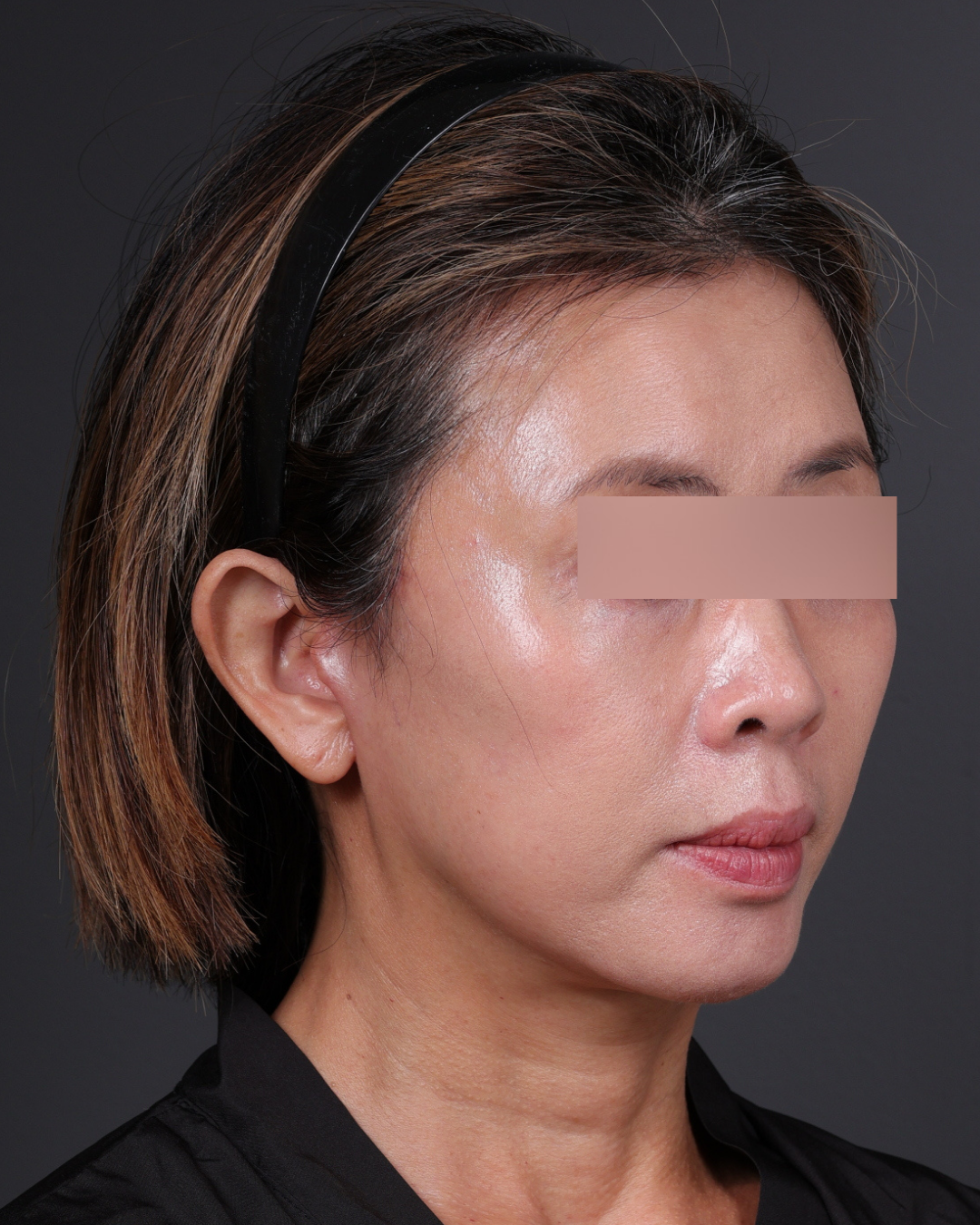 Facelift Before & After Gallery - Patient 178633 - Image 4