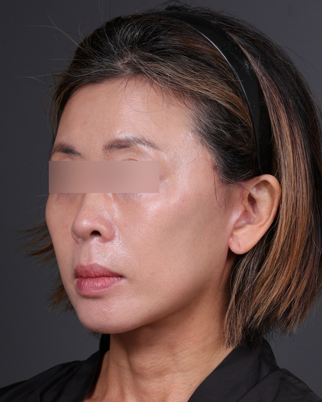 Facelift Before & After Gallery - Patient 178633 - Image 8