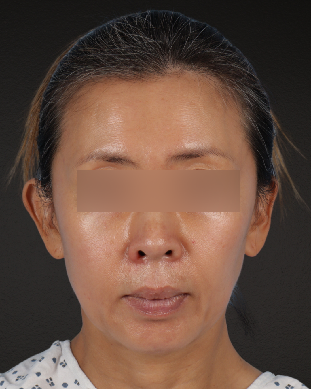 Facelift Before & After Gallery - Patient 178633 - Image 5