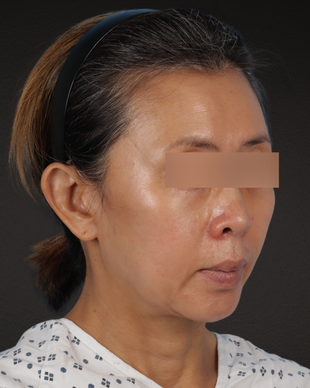 Facelift Before & After Gallery - Patient 178633 - Image 3