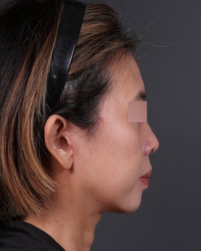 Facelift Before & After Gallery - Patient 178633 - Image 2