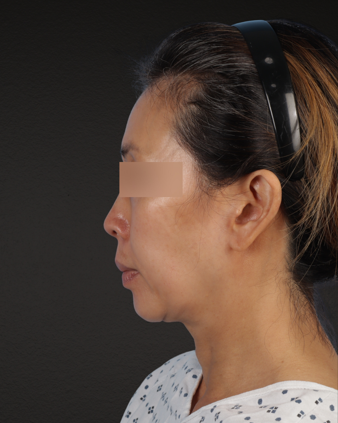 Facelift Before & After Gallery - Patient 178633 - Image 9