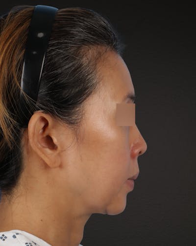 Facelift Before & After Gallery - Patient 178633 - Image 1