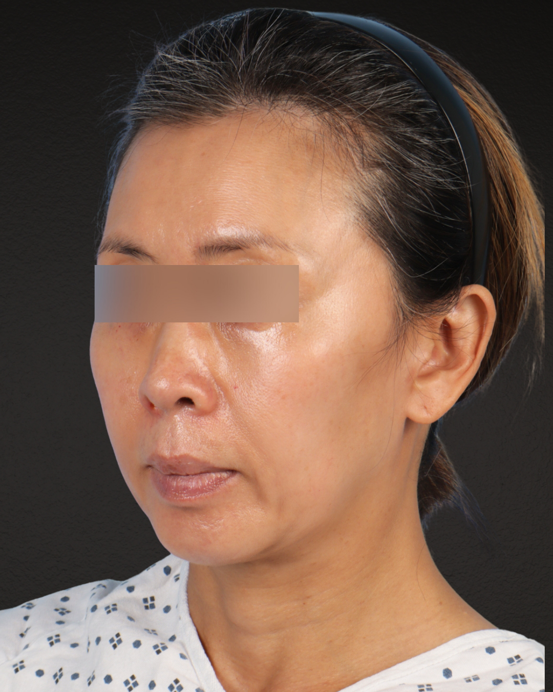 Facelift Before & After Gallery - Patient 178633 - Image 7