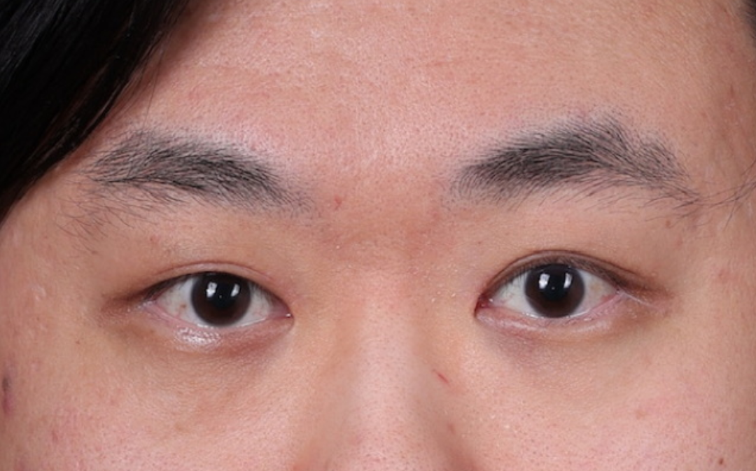 Blepharoplasty Before & After Gallery - Patient 402892 - Image 2